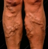 Picture of VR THERAPY CENTER VARICOSE VEINS