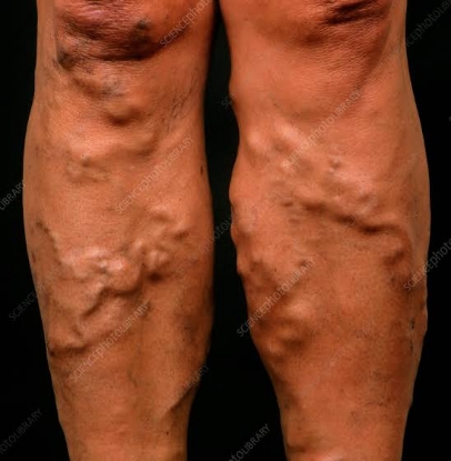 Picture of VR THERAPY CENTER VARICOSE VEINS