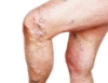 Picture of VR THERAPY CENTER VARICOSE VEINS