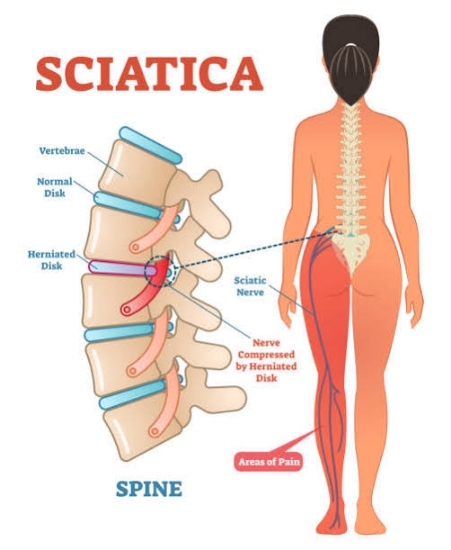 Picture of VR THERAPY CENTER SCIATICA