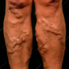 Picture of VR THERAPY CENTER VARICOSE VEINS