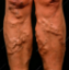 Picture of VR THERAPY CENTER VARICOSE VEINS
