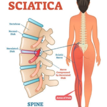 Picture of VR THERAPY CENTER SCIATICA